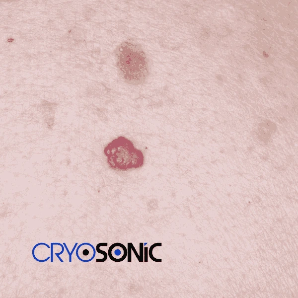 Looking for pain free cherry angioma removal treatment Fareham? Call our team today! Fareham