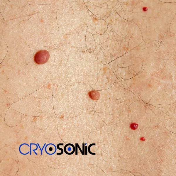 get cherry angioma removal treatment today! Fareham