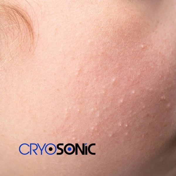 Are you looking for milia removal treatment? Contact our team today Fareham