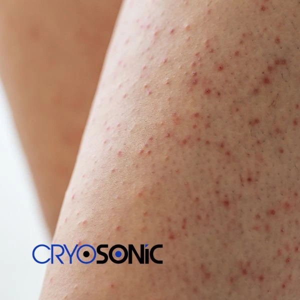 Looking for Seborrhoeic Keratosis removal Fareham treatment? Call our consultants today in Fareham