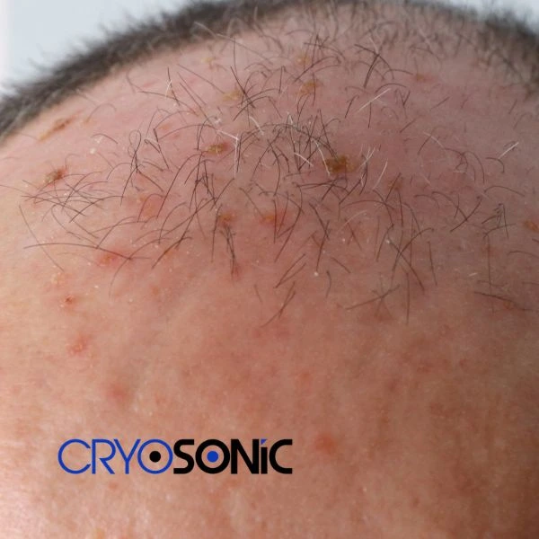Access Seborrhoeic Keratosis removal from the comfort of your own home! Call us today in Fareham