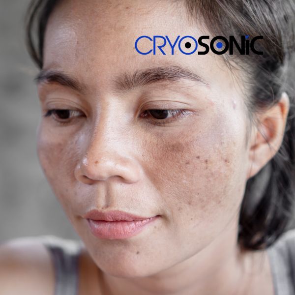 Ready to start age spots removal? Contact our team today in Fareham