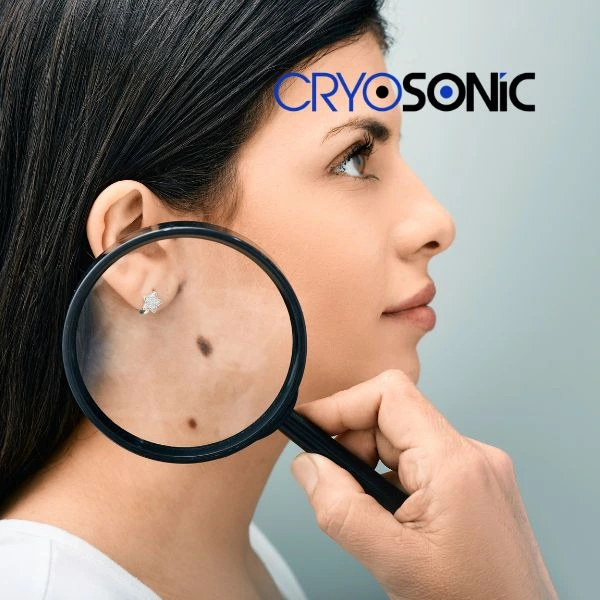 Do you want to learn more about benign moles removal treatment? Call our team today Fareham