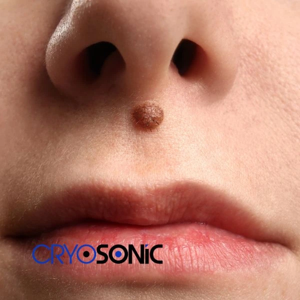 Start your benign moles removal treatment today Fareham