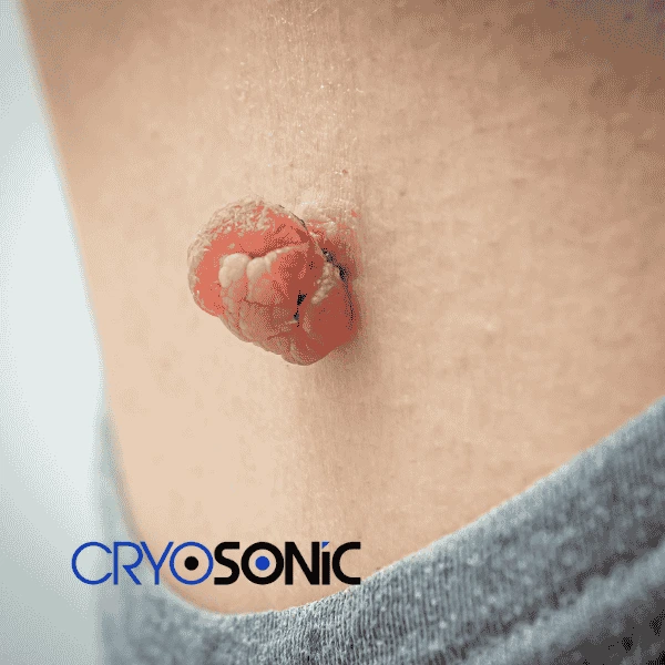 Book your skin tags removal Fareham from comfort of your own home! Fareham