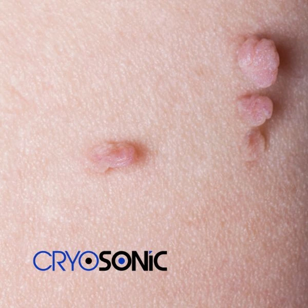 Are you looking for fast effect skin tag removal Fareham? Book in NOW! Fareham
