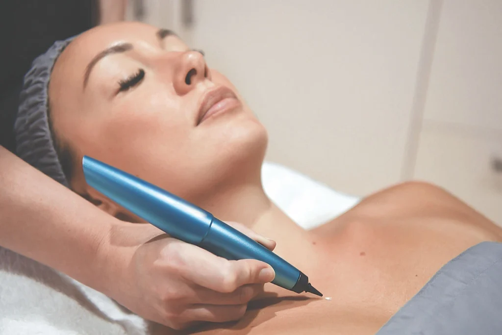 How long does it take for a cryopen procedure to show results Fareham