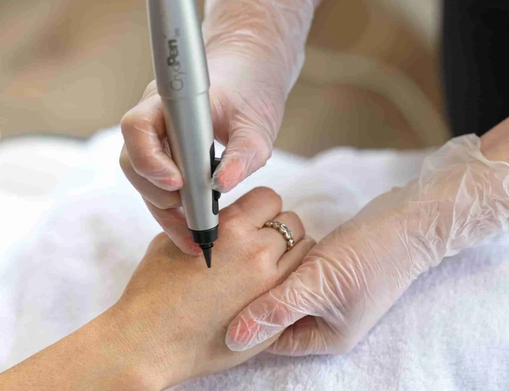 Is Cryosonic Safe for All Skin Types Fareham