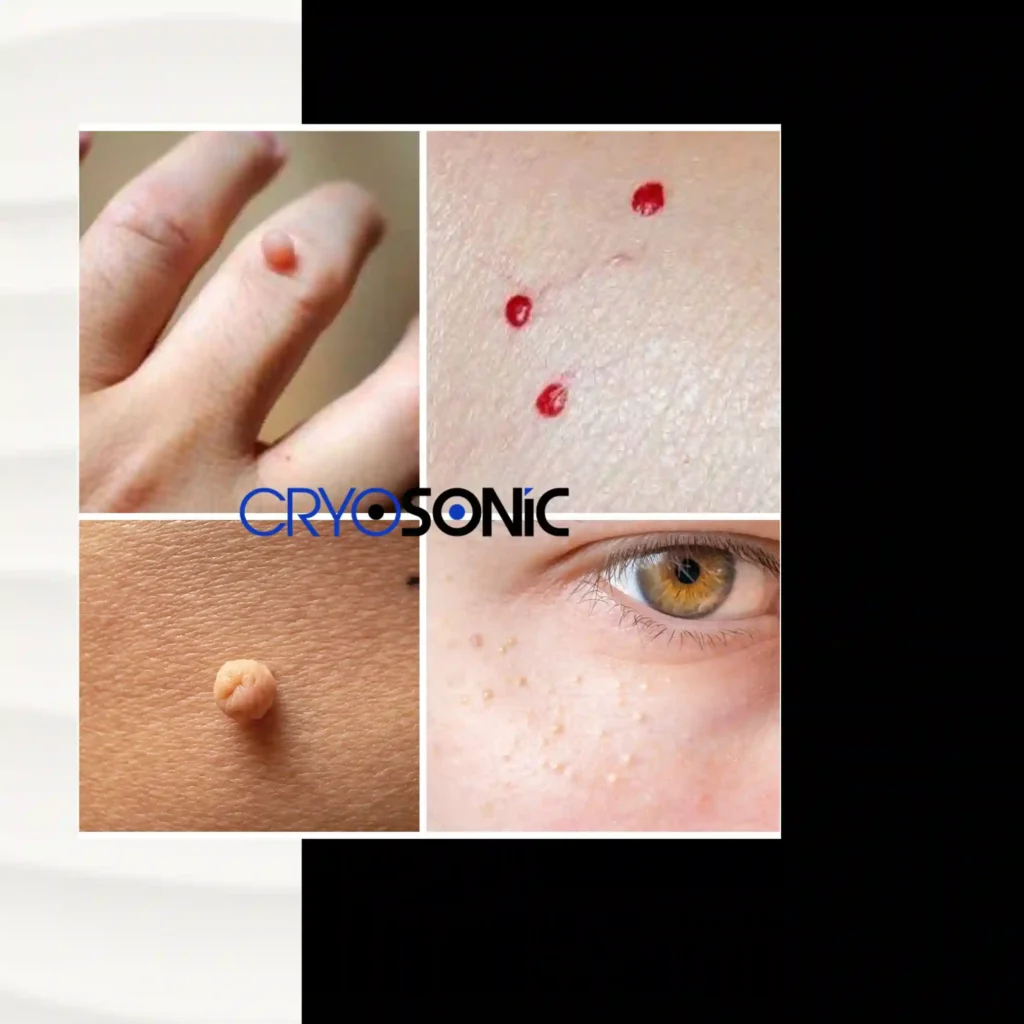 What Are the Different Types of Benign Skin Lesions – and How They’re Treated with CryoPen Fareham