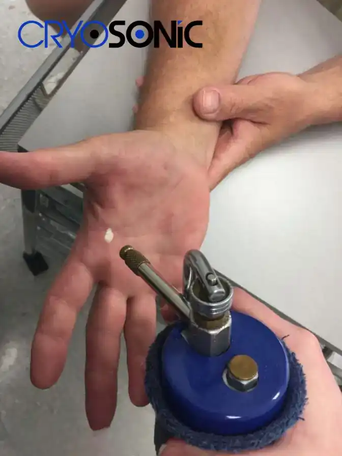 Temperature Differences: OTC vs Medical-Grade Cryotherapy Fareham